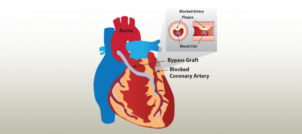 Image of a heart graphic showing blockage