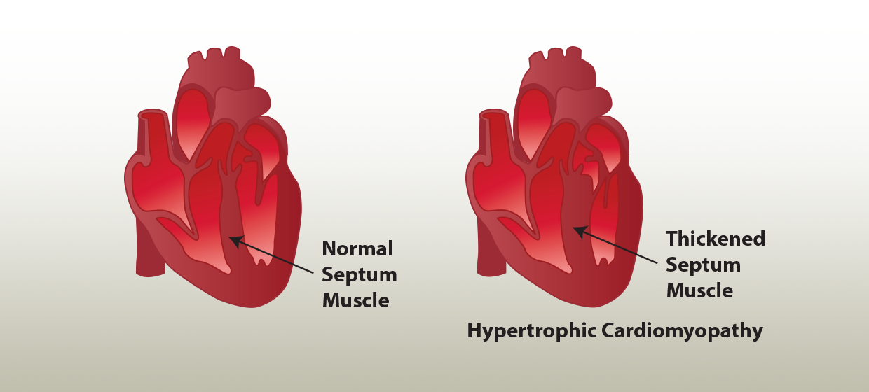 Hypertrophic cardiomypathy diagram