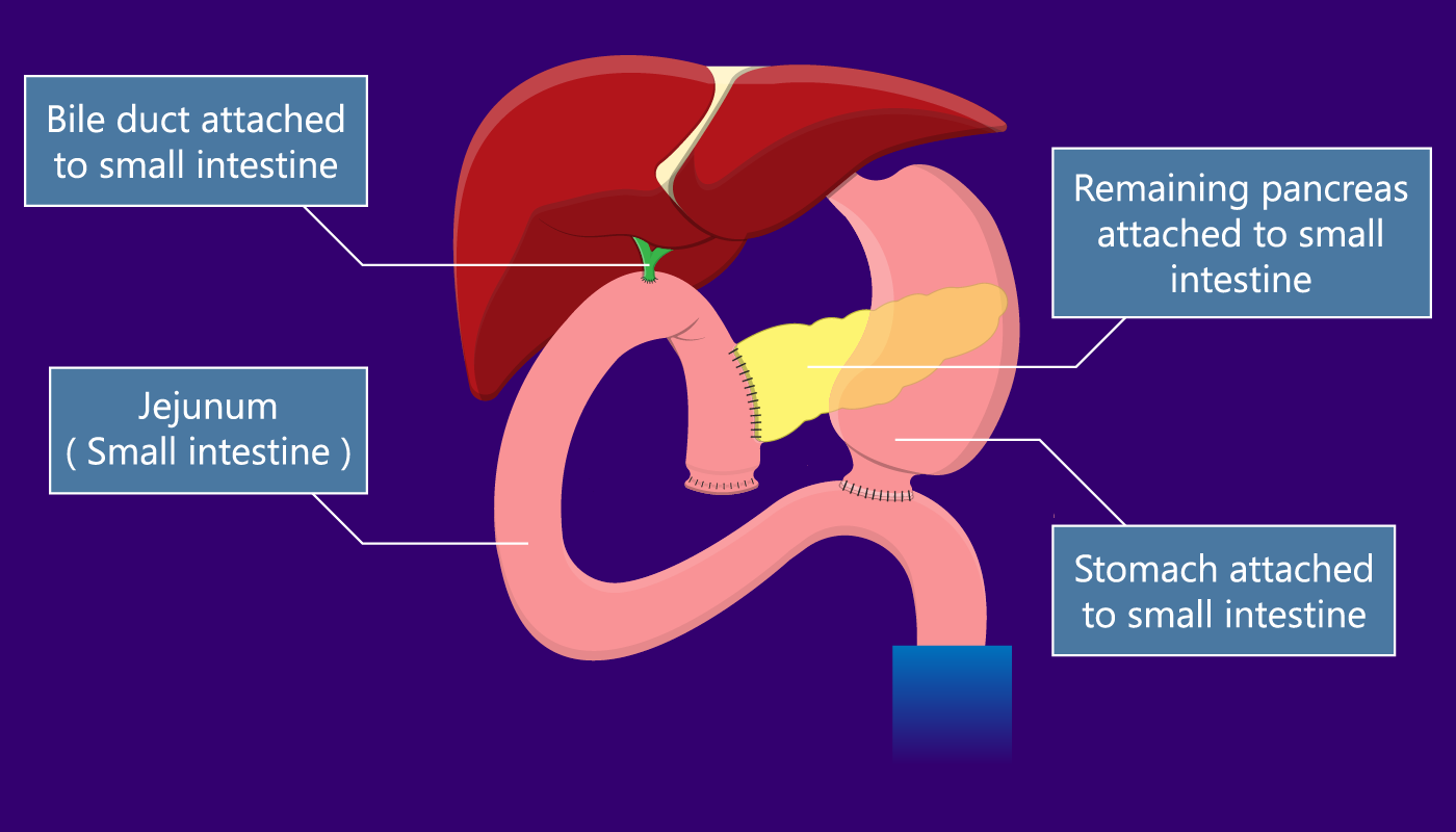 Whipple procedure (pancreaticoduodenectomy) - Step-3