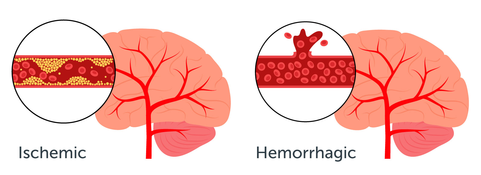 Ischemic and Hemorrhagic Stroke