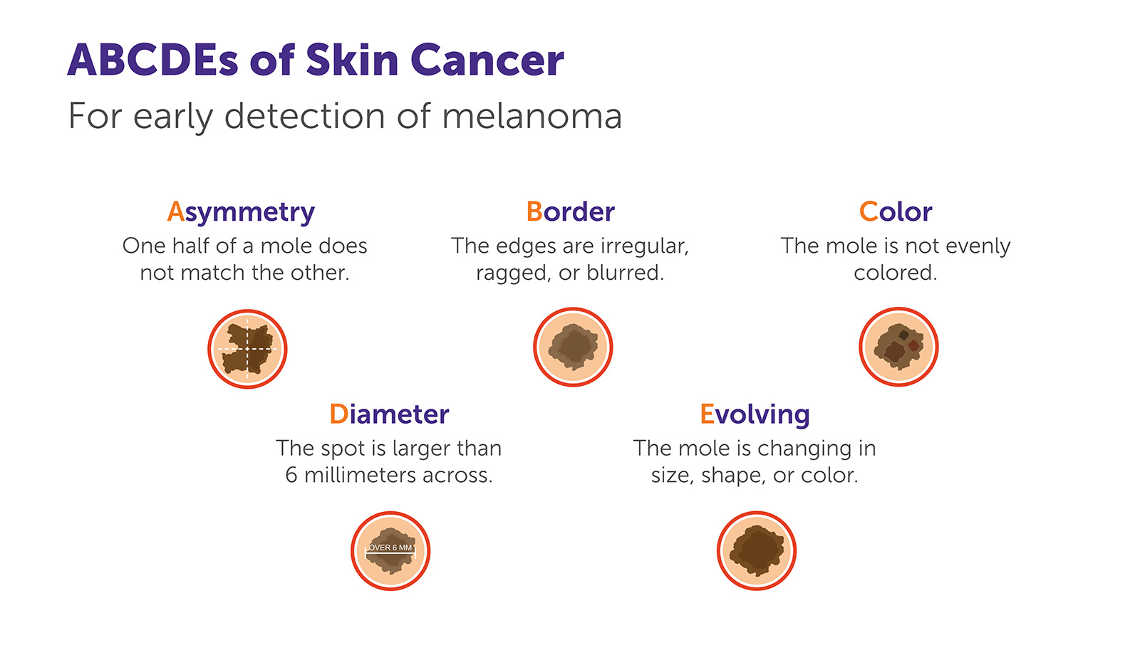 ABCDE's of Skin Cancer